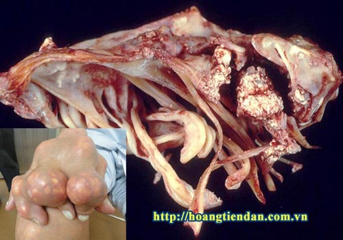 Hình ảnh bên trong khi phẫu thuật hạt tophi người bệnh gout