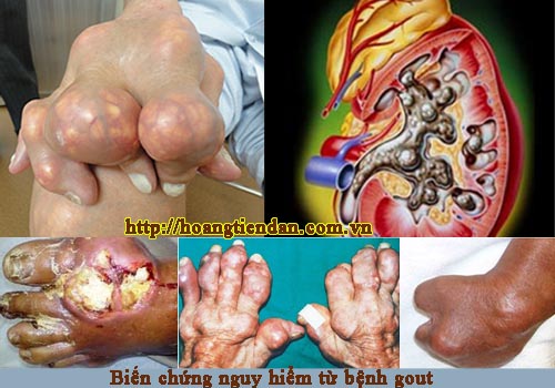 Biến dạng khớp, nhiễm trùng máu, suy thận... là những biến chứng đáng sợ của Gout