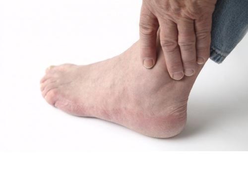 bệnh gout có chữa khỏi được không