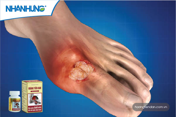 Cần hết sức cảnh giác với những dấu hiệu của bệnh gout