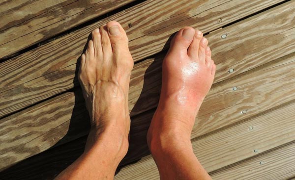 Bệnh gút khiến rất nhiều người điêu đứng