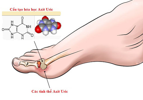 Axit uric tích tụ tại ngón chân cái