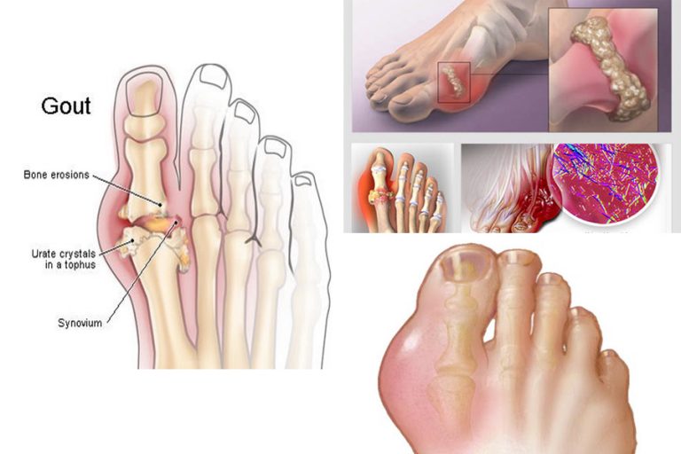 Khắc chế bệnh gout