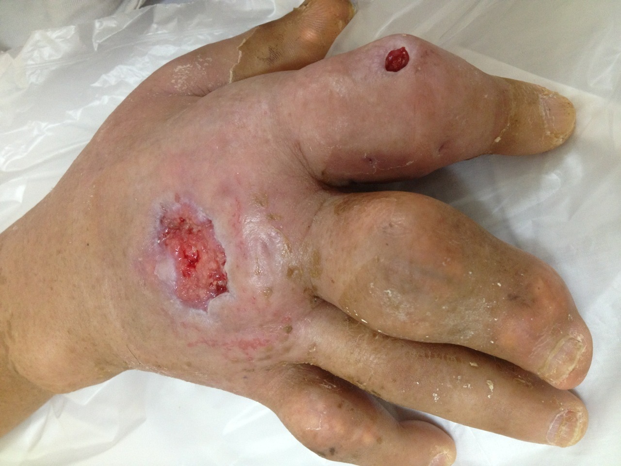 Nguy hiểm khi hạt tophi vỡ và nở loét ở bàn tay