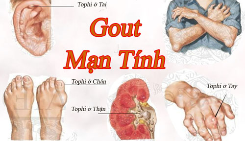 Khi gút “lên ngôi” cơ thể xuất hiện nhiều hạt tophi, không loại trừ hạt tophi ở thận 