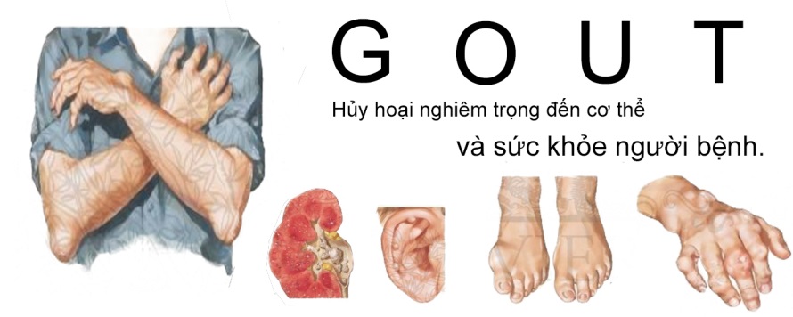 Không thể đốt cháy giai đoạn trong điều trị gout