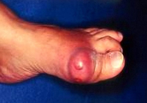 Nguy hiểm khi tự điều trị bệnh gout tại nhà