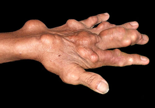 biến chứng sang bệnh gout mãn tính