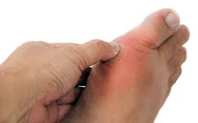 Cách đề phòng bệnh gout hiệu quả