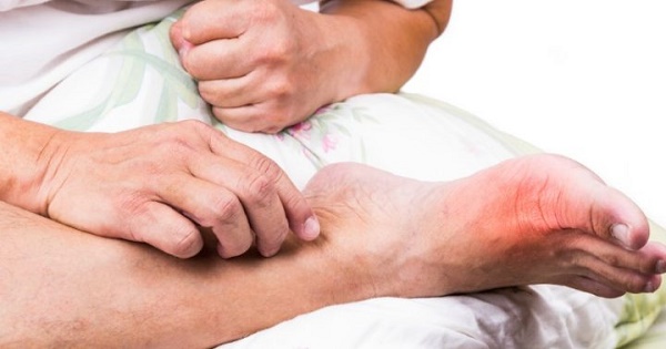 Sự chủ quan sẽ tiếp tay cho gout chuyển sang mạn tính