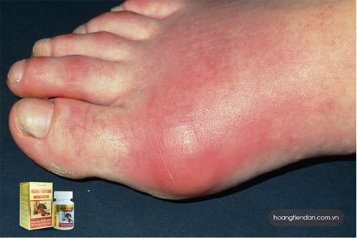 Suy giảm chức năng thận dẫn đến bệnh gút mạn tính