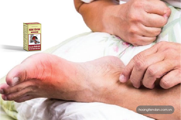 Bệnh gút và yếu sinh lý luôn song hành cùng nhau