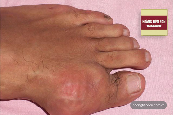 Cây Tơm Trơng – “trợ thủ đắc lực” của người mắc gút