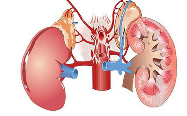 Chức năng thận suy yếu gây ra gút mạn tính