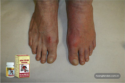 Cơn đau gút triền miên khiến người bệnh gút không thể “yêu” dù rất muốn