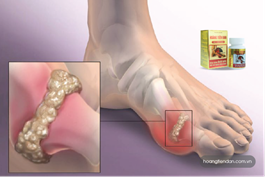 Điều trị gút sai cách khiến bệnh trầm trọng hơn