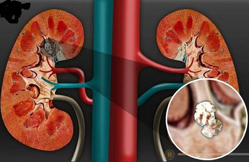 Suy giảm chức năng thận đồng thời gây ra hai bệnh gút và yếu sinh lý