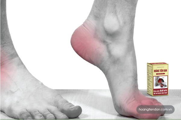 Triệu chứng đầu tiên của bệnh gút phát hiện ở ngón chân cái sau đó lan ra các ngón, bàn, khớp cổ chân và đau các khớp ngón tay, cổ tay