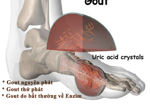 Căn cứ vào biểu hiện và giai đoạn của bệnh gout
