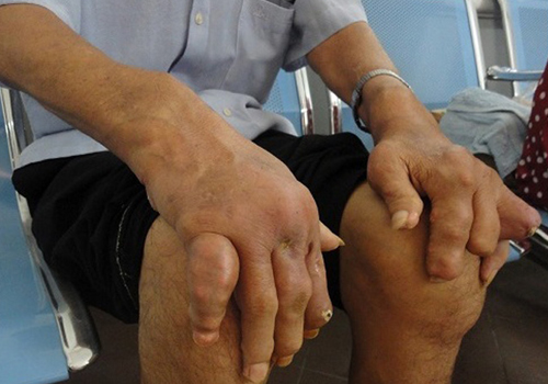 Hình ảnh - Nguyên nhân và biểu hiện bệnh gout