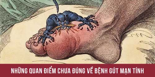 Quan điểm chưa đúng về bệnh gout