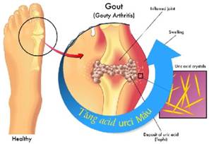 Acid uric – sản phẩm cuối cùng trong quá trình thoái biến nhân purin