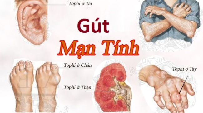 Chức năng thận suy giảm tiếp tay cho gút mạn tính hoành hành