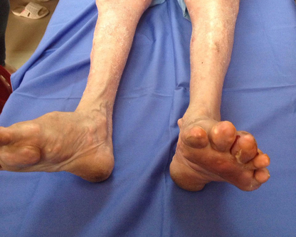 Có thể bị tàn phế khi bị gút mãn tính