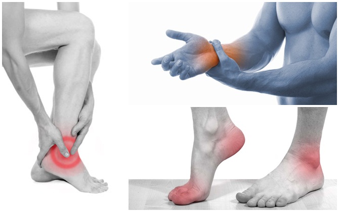 Cơn đau lặp đi lặp lại nhiều lần là dấu hiệu của gout mạn tính