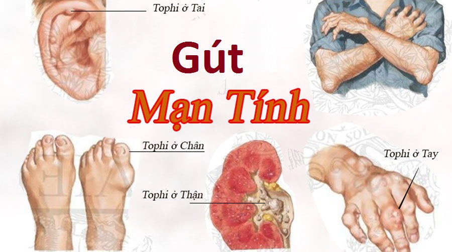 Dấu hiệu của bệnh gút mãn tính