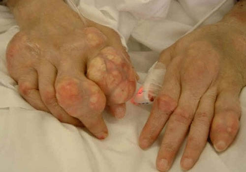 Gout không còn là nỗi ám ảnh