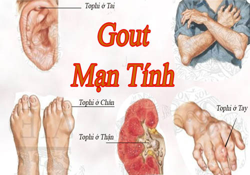 Những biểu hiện triệu chứng của bệnh gout mãn tính: thận yếu, chân tay nổi nhiều hạt tophi gây đau đớn...