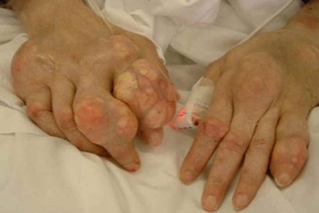 Hạt tophi – một trong những biểu hiện của gout mạn tính