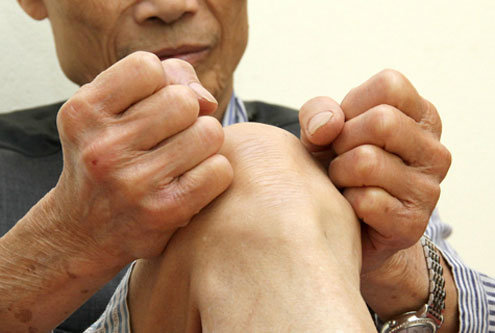 Người bệnh có thể bị thoái hóa khớp nếu mắc giả gout