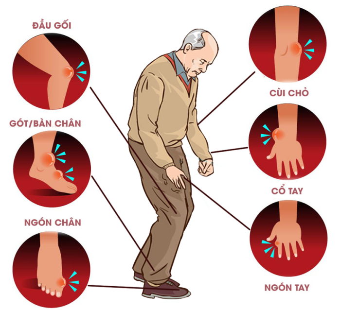 Dấu hiệu của bệnh gout: Cách nhận biết cấp độ bệnh gout qua từng giai đoạn