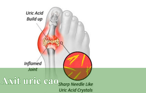 Rất có thể axit uric sẽ tăng cao