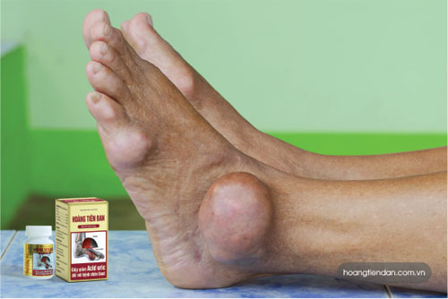 Rất nhiều người loay hoay tìm đường thoát gút mạn tính