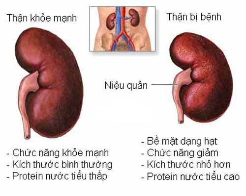 Thận yếu nguyên nhân hàng đầu gây bệnh gút