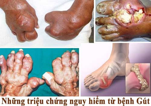 Hình ảnh của bệnh gout mãn tính bạn cần biết