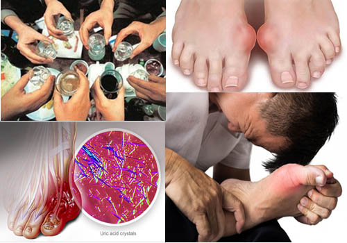 Triệu chứng bệnh gout ở người thường xuyên sử dụng rượu bia
