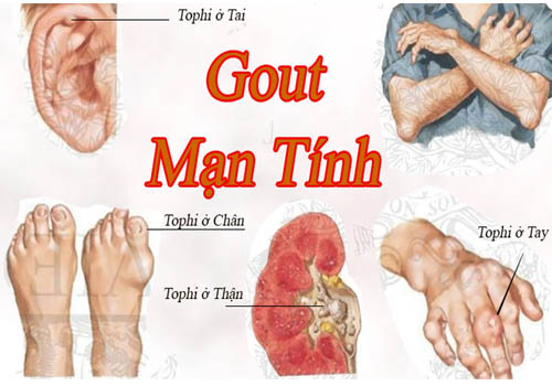 Triệu chứng gây đau của bệnh gout cần lưu ý