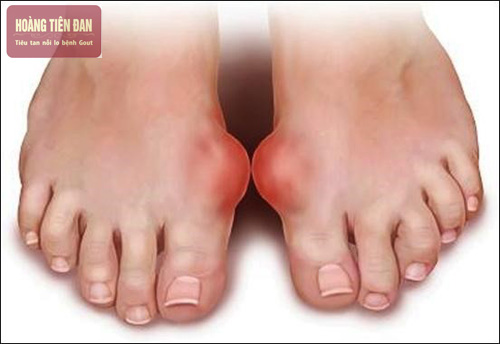Ăn mặn có thể khiến bệnh gout ngày càng nghiêm trọng hơn