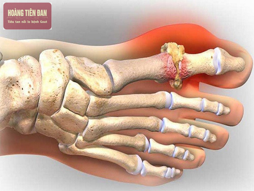 Bị bệnh gout nên kiêng ăn cá hồi