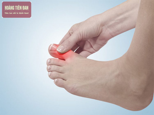 Bệnh gout có nên vận động không?