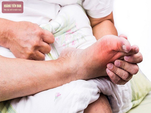 Đầu ngón chân là nơi có biểu hiện đầu tiên của bệnh gout