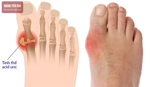 Bệnh gút có thể gây những cơn đau và có một số biến chứng