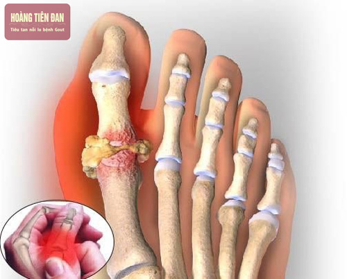 Người bị bệnh gút sẽ cảm thấy những cơn đau dữ dội ở các khớp