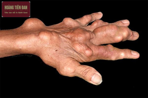 Bệnh gút kéo dài có thể ảnh hưởng đến vận động