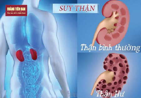 Thận yếu cùng lúc gây ra bệnh gút và suy giảm sinh lý