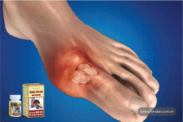 Để thoát khỏi bệnh gút nhiều người tìm đến thuốc giảm đau